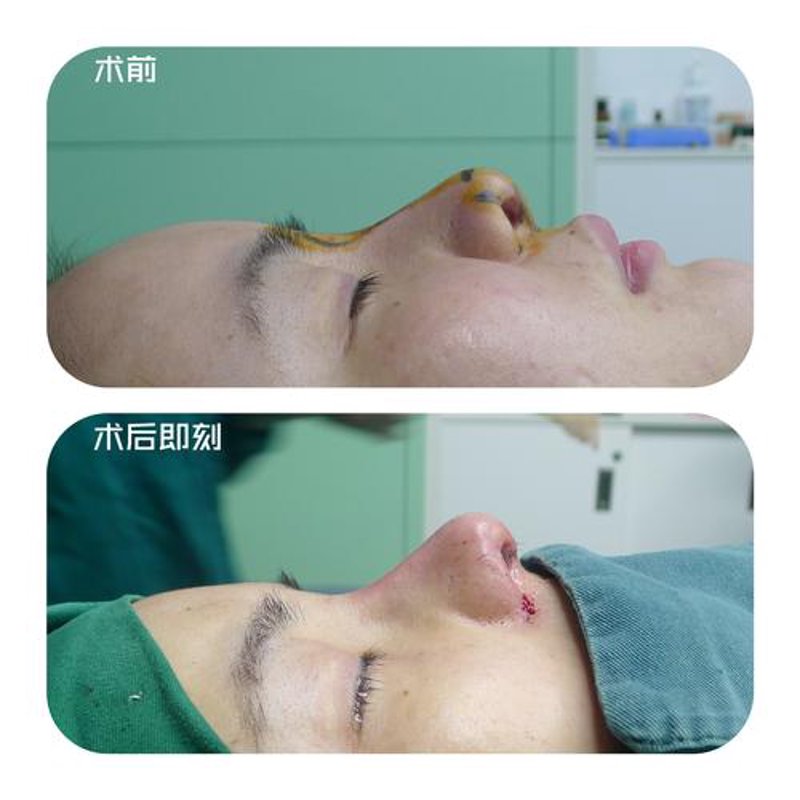 隆鼻手术:重塑你的魅力之桥