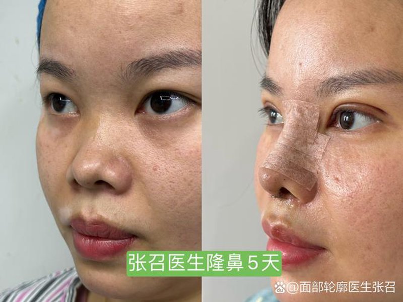 脂肪移植