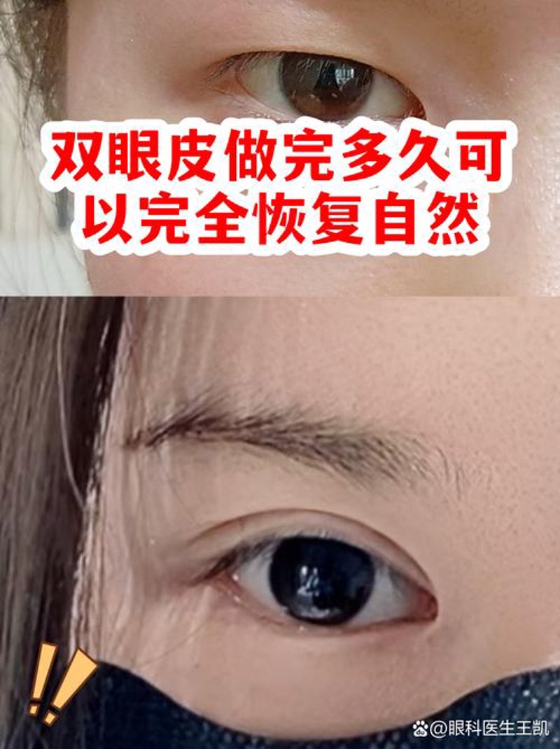隆鼻手术迎来新趋势